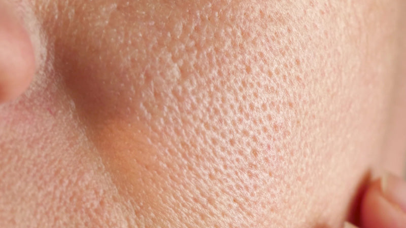 Enlarged Pores